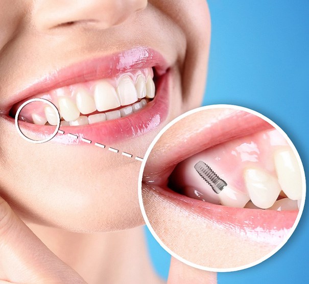 A photo highlighting a smiling woman’s complete dental implant