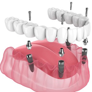 Illustration of an implant denture
