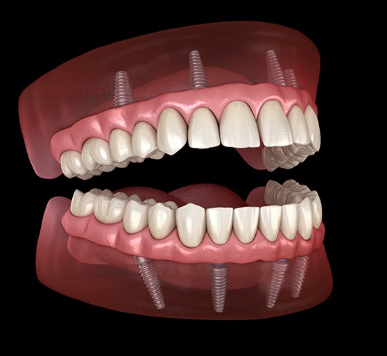 All-on-X illustration