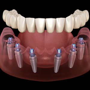 Digital illustration of implant dentures