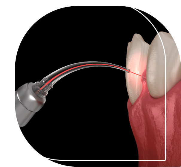 Illustrated dental laser treating the gums