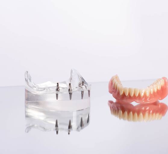 Sample dentures next to transparent base with 4 dental implants