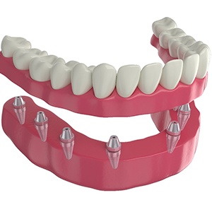 Illustration of fixed implant dentures above low arch with implants