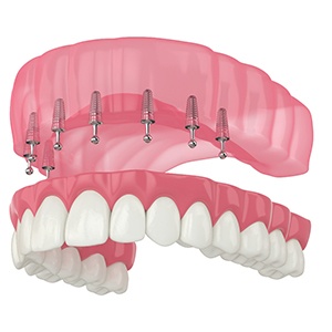 Rendering of ball-joint implant dentures in upper arch with white background