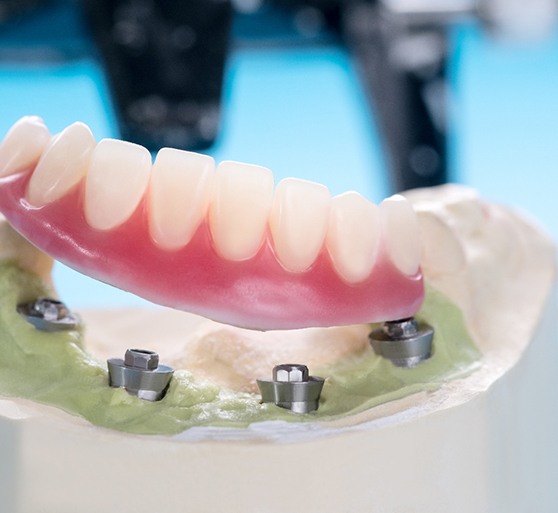 Lower arch of implant dentures over cast with 4 implants