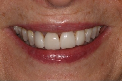 Mouth with small yellow stains on some teeth