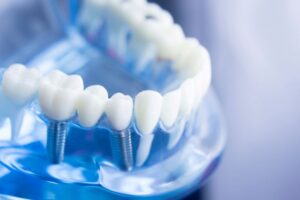 Dental model with two dental implants 