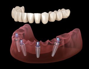 Illustration of All-on-4 dental implants
